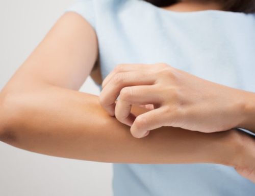 Mosquito Bites and Home Remedies